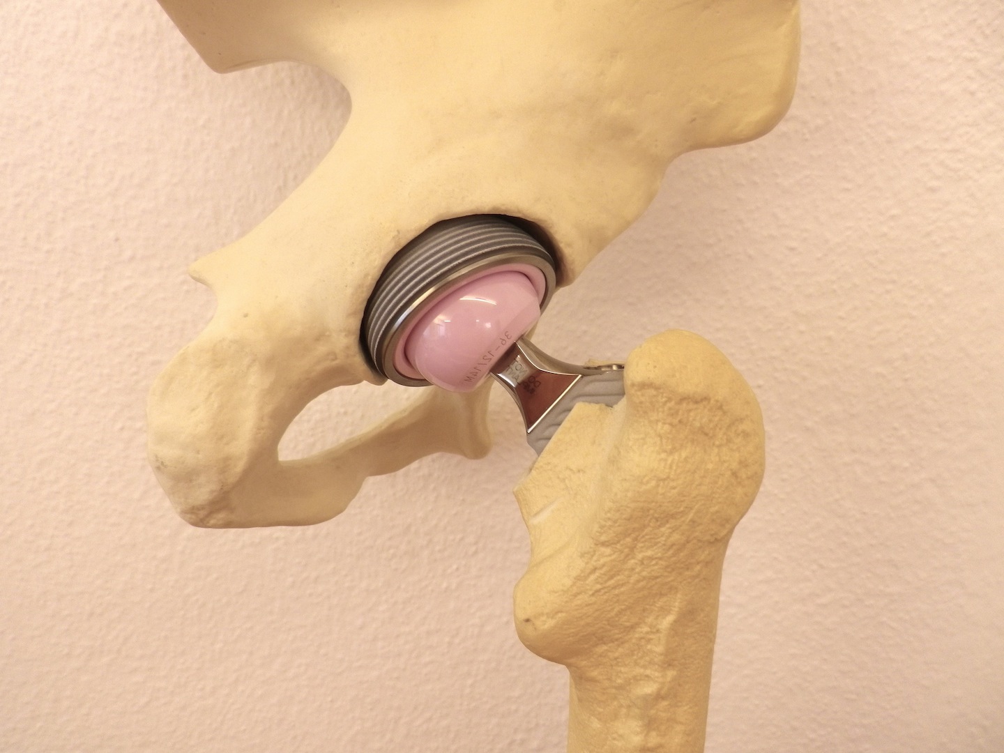 pimp my vioque: bien tunné sa hanche artificielle