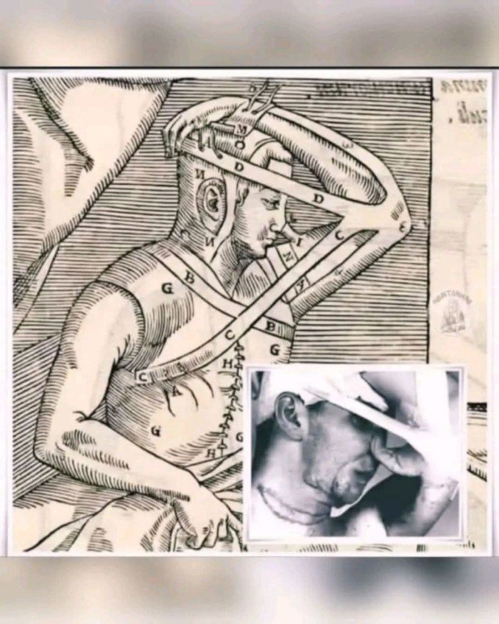 Technique de rhinoplastieAu XVIe. (Suite en com).