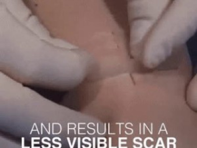Points de suture - Nouvelle technique à venir