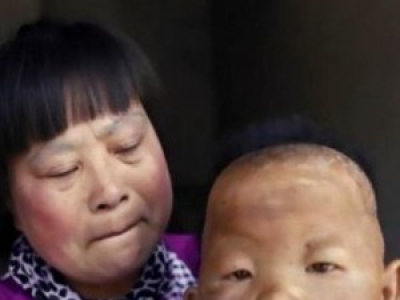 En Chine, cet homme ressemble toujours à un bébé à cause d'une maladie rare
